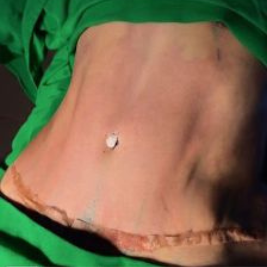 ozonioterapia-para-cicatrização-dra-vania-enfermeira-dermatologica